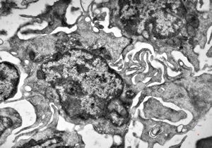 M,73y. | bone marrow - hairy cell leukemia